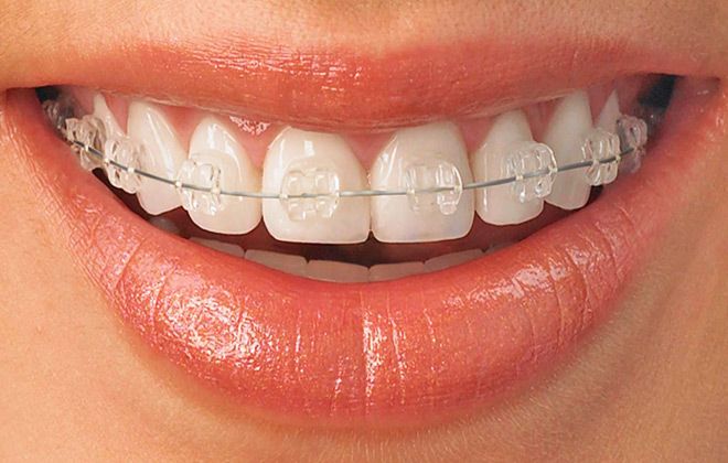 Aparat dentar metalic pentru 1 arcada consultatie plan tratament model de studiu manopera la pretul de doar 990 lei in loc de 1900 lei la Young Smile Dental Clinic!