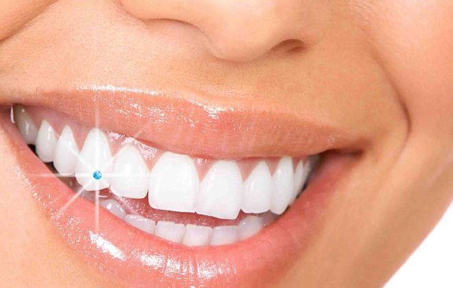 Bijuterie dentara stras diferite forme si culori Consultatie stomatologica Plan de tratament Sfaturi igiena orala la doar 69 lei in loc de 120 lei la Cabinet Mitrea Dental!