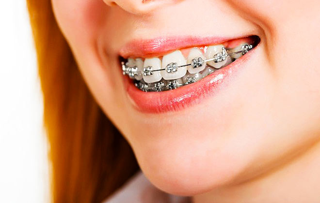 Imagine cupon oferta -
Indreptarea dintilor la orice varsta!
Dinti perfect drepti! Aparat dentar metalic pentru 1 arcada + consultatie stomatologica + plan tratament + model de studiu + manopera, la doar 890 lei in loc de 1800 lei, numai la Young Smile Dental Clinic!