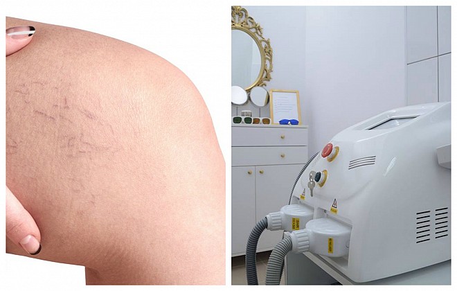 Imagine cupon oferta -
Spune adio venelor sparte!
Picioare sanatoase! 1 sedinta sau 2 de tratare vase capilare sparte cu laser dioda pentru fata, umeri, spatele genunchiului sau pentru intregul picior incepand de la doar 179 lei in loc de 300 lei, numai la Dermepil!