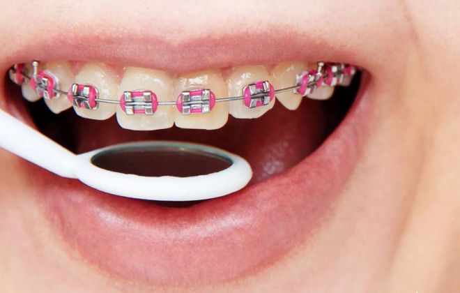 Reorganize shepherd Intestines Aparat dentar din safir! | Dental Clinique! Aparat dentar transparent sau din safi... Aparat dentar safir Reorganize shepherd Intestines Aparat dentar din safir! | Dental Clinique! Aparat dentar transparent sau din safi... Aparat dentar safir