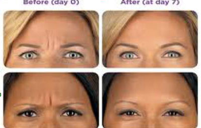 elimina ridurile de pe frunte botox cel mai bun regim de frumusețe anti-îmbătrânire